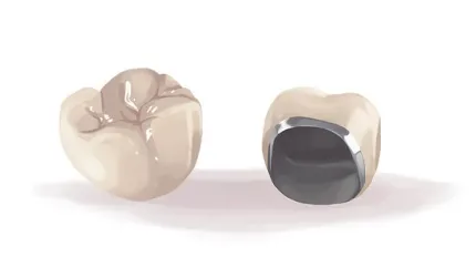 Dental Crown Procedure